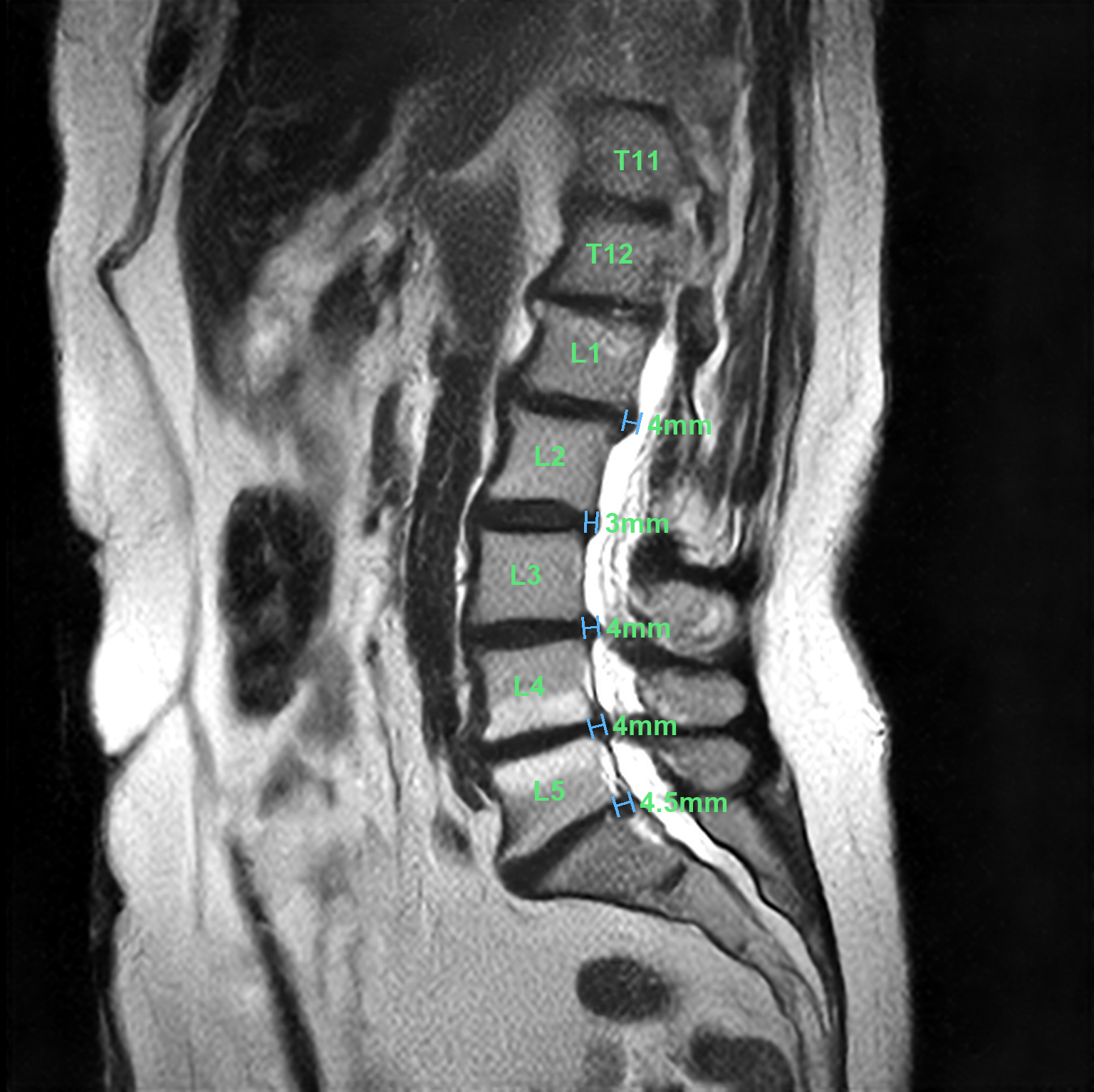 De-identified lumbar spine MRI with vertebral levels labeled T11 through L5 and dictated herniation measurements rendered as calipers